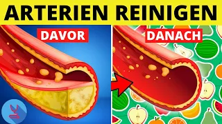 Diese Top 4 Lebensmittel reinigen deine Arterien und helfen bei der Vorbeugung von Arteriosklerose