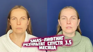 SMAS-лифтинг. Результат операции через 3.5 месяца