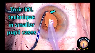 Toric IOL technique in small pupil cataract surgery