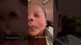 How I Cleared my Newborn's Baby Acne in 3 Days