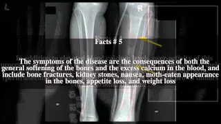 Osteitis fibrosa cystica Top # 7 Facts