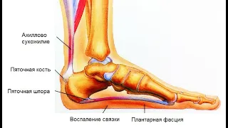 лечение пяточной шпоры народными средствами