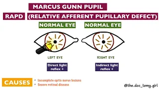 Abnormal Pupillary Reflexes | Ophthalmology