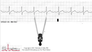 ECG Interpretation Tutorial - ChalkTalk 05 - Basic Level