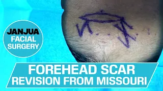 PART 1: FOREHEAD SCAR REVISION FROM MISSOURI - DR. TANVEER JANJUA - NEW JERSEY