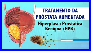 Tratamento da Próstata Aumentada | Hiperplasia Prostática Benigna (HPB)