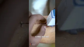 How Medical Staples Work 🤔 (Hindi) #shorts #views #trending #viral #toptrending