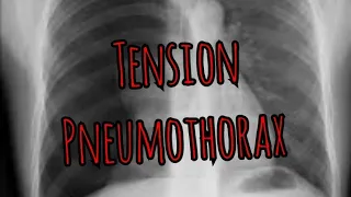 The Basics: Treating Tension Pneumothorax