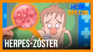 Você e o Doutor: Saiba tudo sobre a herpes-zóster, doença causada pelo vírus da catapora