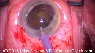 Cataract Surgery with a midsize pupil without using iris hooks or expansion devices