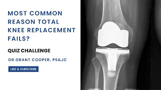 Most Common Reason Total Knee Replacement Surgery Fails? Daily Quiz Challenge