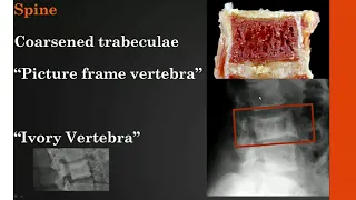 Imaging Paget disease of bone