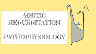 Aortic regurgitation: pathophysiology