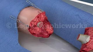 Leg Amputation Surgery 3D animation