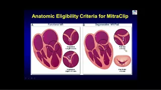 Transcatheter Mitral Valve Therapy: Update