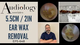 5.5CM/2IN EAR WAX REMOVAL - EP648