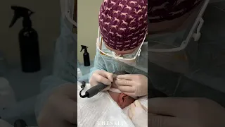 Трансплантация волос в лобно-височную зону и зону макушки!