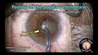 CataractCoach 1454: peeling off the pupillary membrane