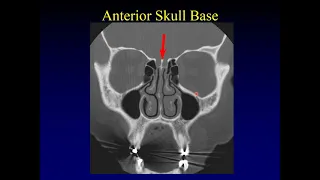 Imaging of the Paranasal Sinuses 1