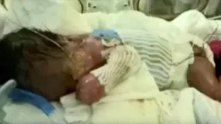 Baby born without skin getting life-saving treatment