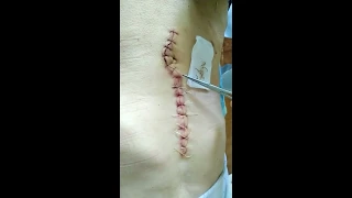 suture removal.снятие швов