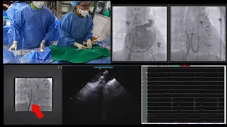 WATCHMAN #6  2nd trans septal puncture