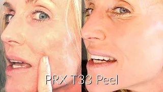 REPAIR SUN DAMAGE & BUILT COLLAGEN WITHOUT DOWNTIME? | AT HOME 33% "no peel" TCA PEEL | PRX T33 PEEL