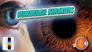 Nummular keratitis - Your EYEBALLS - EYNTK 👁️👁️💉😳💊🔊💯✅