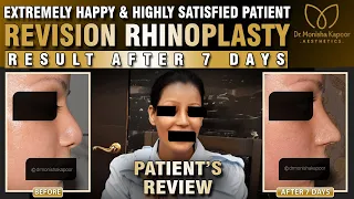 Extremely Happy & Highly Satisfied Patient Review  |  Revision Rhinoplasty  | Results after 7 Days