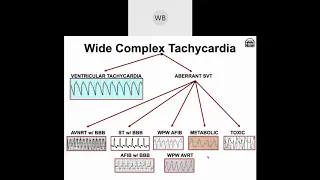 Wide Complex Tachyarrhythmias: Part 1- Origins of VTach & SVT with Aberrancy