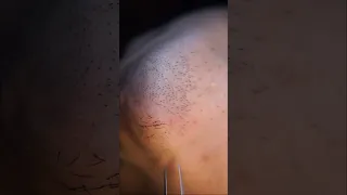 ingrown hair pull out speedx2 with tweezers!  Satisfying 221 #shorts #satisfying  #well  #removal