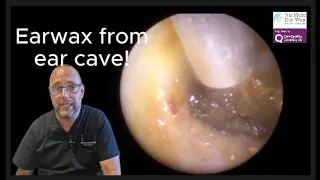 Ear wax removed from ear cave! - Episode 74 #earwaxremoval #ear #earwax