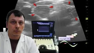 Pediatric thymus gland ultrasound - Decreased echogenicity of the thymus lobe