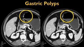 MDCT Evaluation of Gastric Malignancies: Adenocarcinoma, GIST & Beyond Part 3