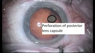 Traumatic cataract