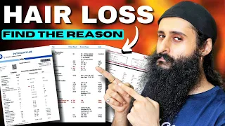 Do These Tests If You Have Hair Loss/ Hair Fall/ Male Pattern Baldness - Bearded Chokra