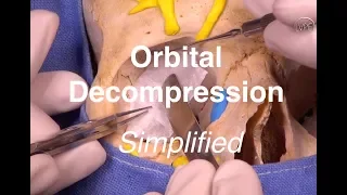 Orbital Decompression Simplified