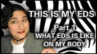 What EDS is like on MY Body #ThisIsMyEDS Tag [CC]