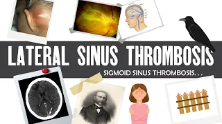 Lateral sinus thrombosis|Sigmoid sinus thrombosis|thrombophlebitis Griesinger’s Crow beck Tobey ayer