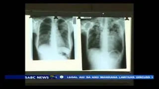 WHO warns in TB report that 3 million escape diagnosis