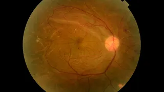 Chapter 10: Advanced TRD for diabetic retinopathy