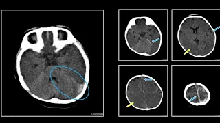 Subdural Hemorrhage |  Interesting Radiology Cases