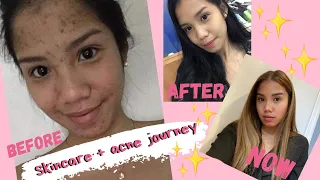 SUPER AFFORDABLE SKIN CARE ROUTINE (LESS THAN PHP 150)+ ACNE JOURNEY (PHILIPPINES) | Dhen Cayabyab