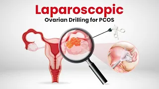 Laparoscopic Ovarian Drilling for PCOS - What is it? Can Ovarian Drilling cure PCOS?