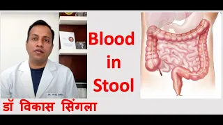 Reason for Blood in Stool : Causes and Treatment in Hindi