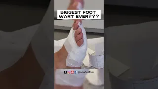 WOW! HUGE FOOT WART EVER??? ***PLANTAR WART REMOVAL SURGERY***