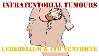 Infra-tentorial Tumours - Cerebellum & 4th Ventricle