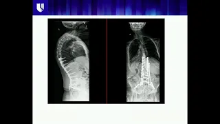 Outcomes of Adult Deformity Surgery - Christopher I. Shaffrey, MD