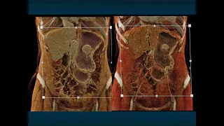 CT of the Stomach: Beyond the Common Gastric Masses - Part 1