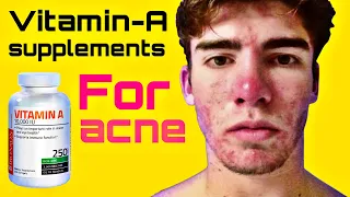Vitamin A for Acne - Taking Vitamin A Supplements for Acne - Natural Acne Treatment